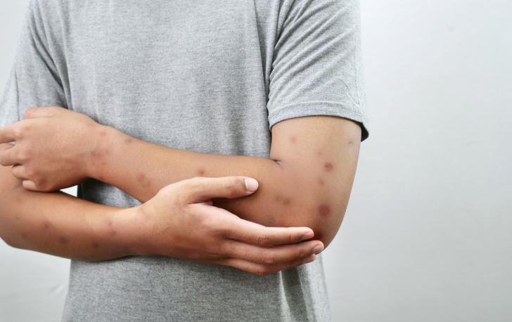 Was ist Prurigo nodularis und inwieweit kann es Sie beeinträchtigen?
